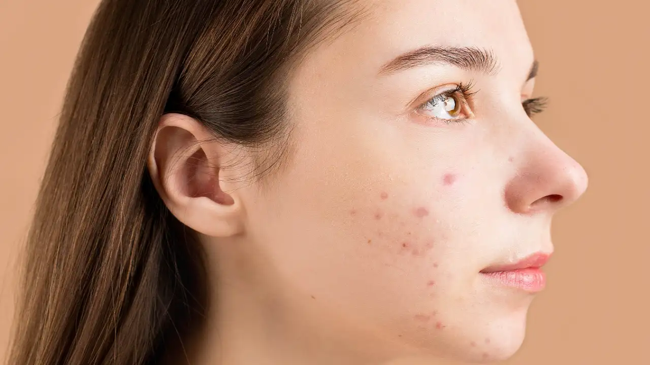 How Vitamin E Can Impact Acne And Skin Health PINKVILLA