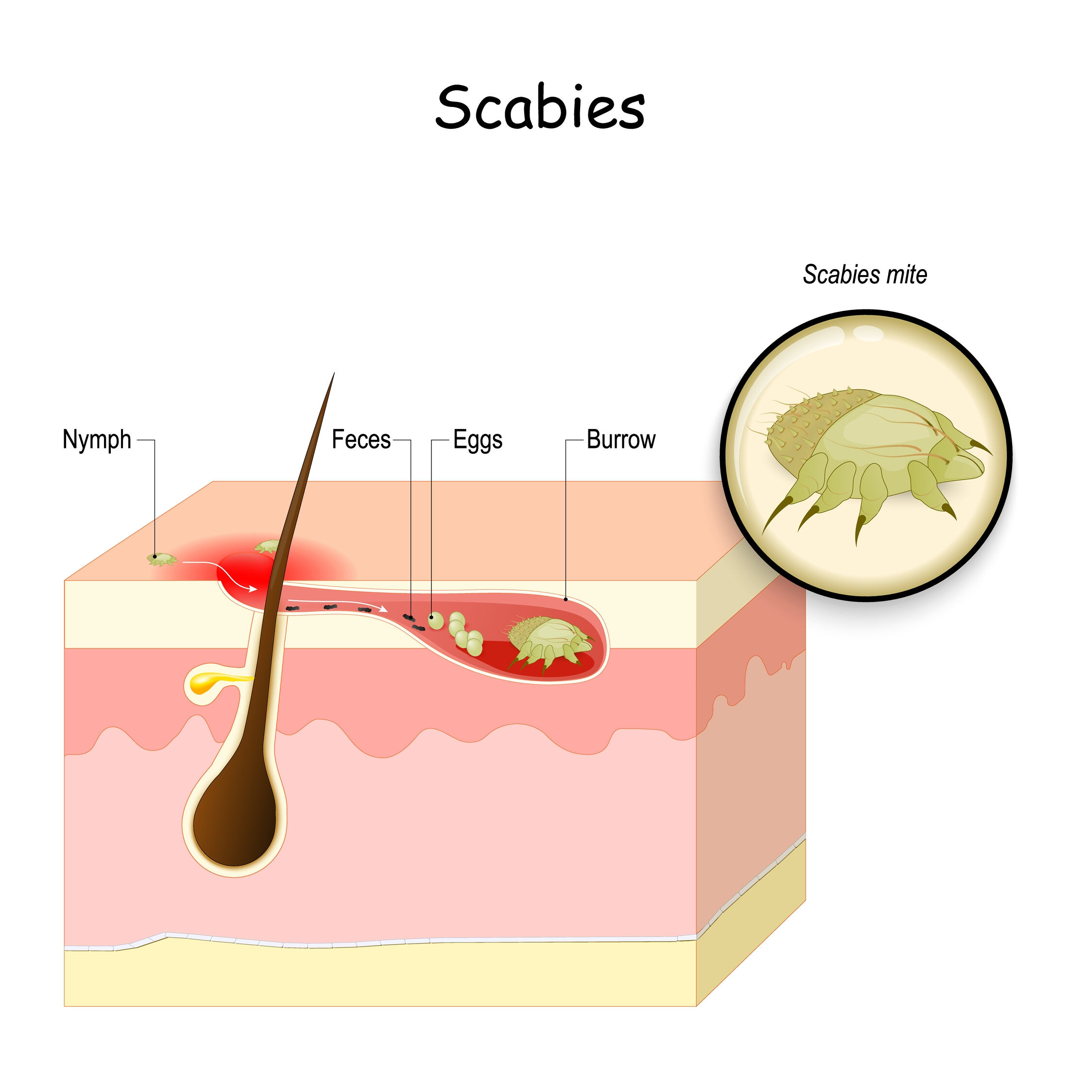 home remedies for scabies