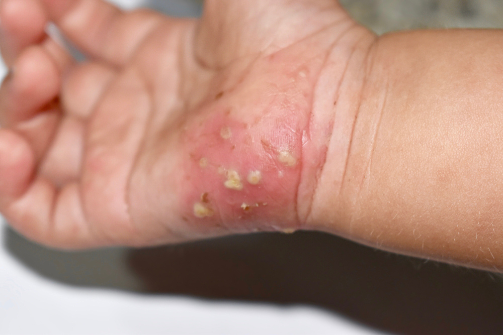 home remedies for scabies