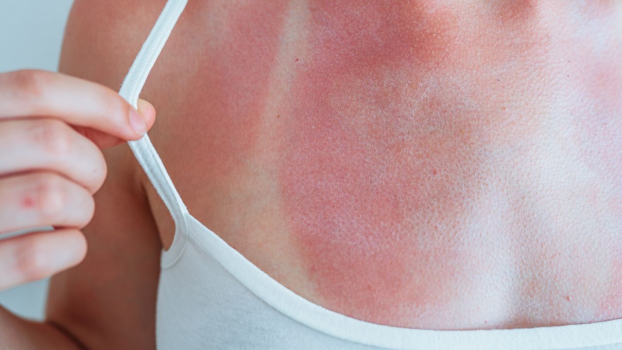 How Long Does Sunburn Last So, What Exactly Is a Sunburn?