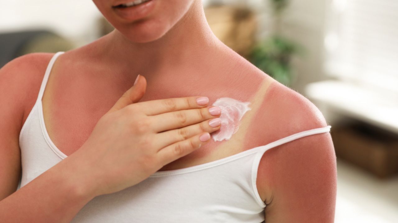 How to Manage a Sunburn? How Long Does Sunburn Last