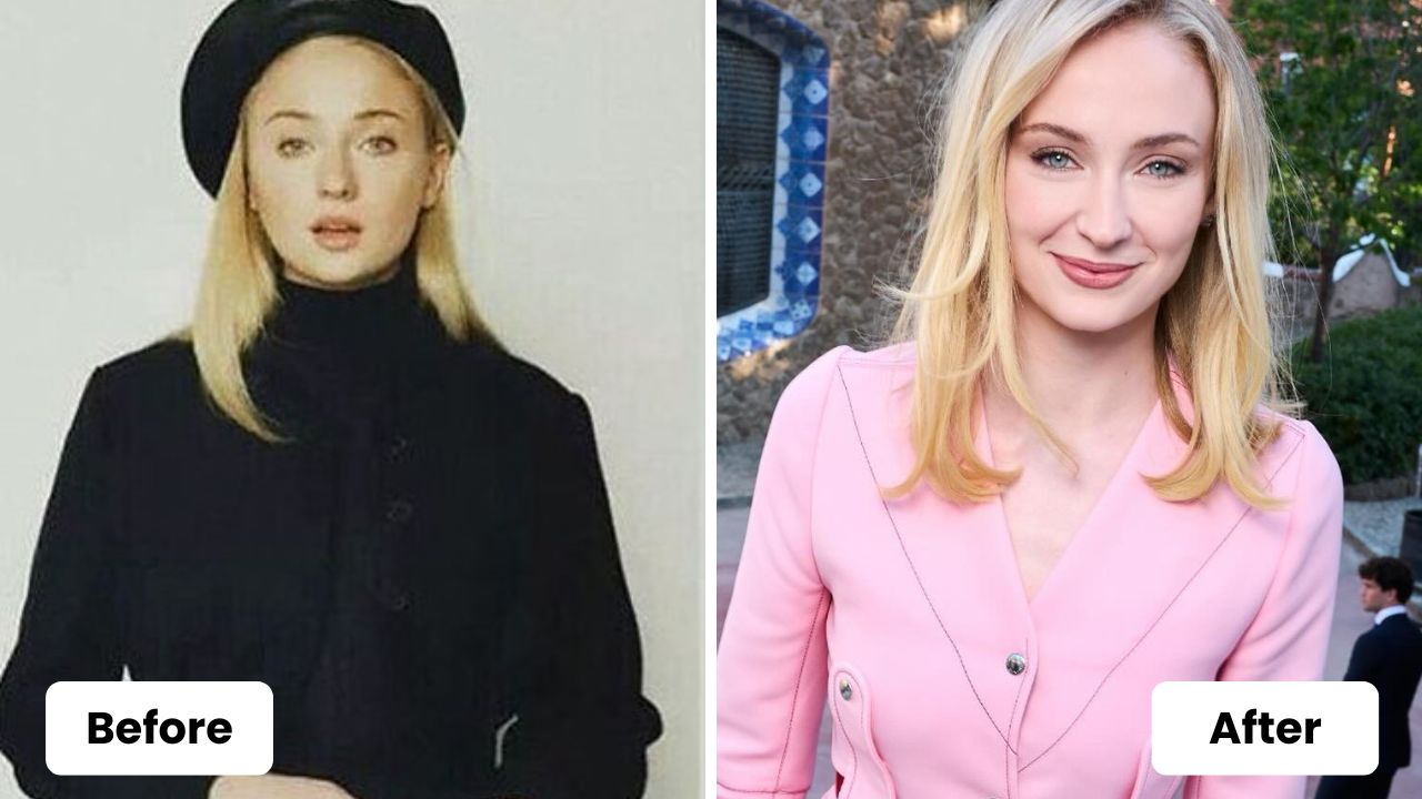 Sophie Turner before and after plastic surgery