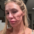 Brandi Glanville of Real Housewives of Beverly Hills Begs for Help After ‘Face Melts Away’ from Unexplained Parasite 'Eating' It Away