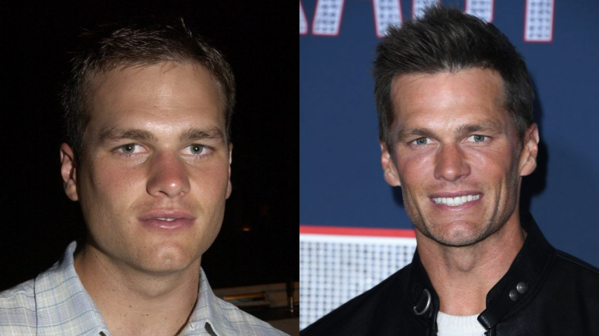 Fact Check: Did Tom Brady Get a Hair Transplant? Exploring Truth Behind ...